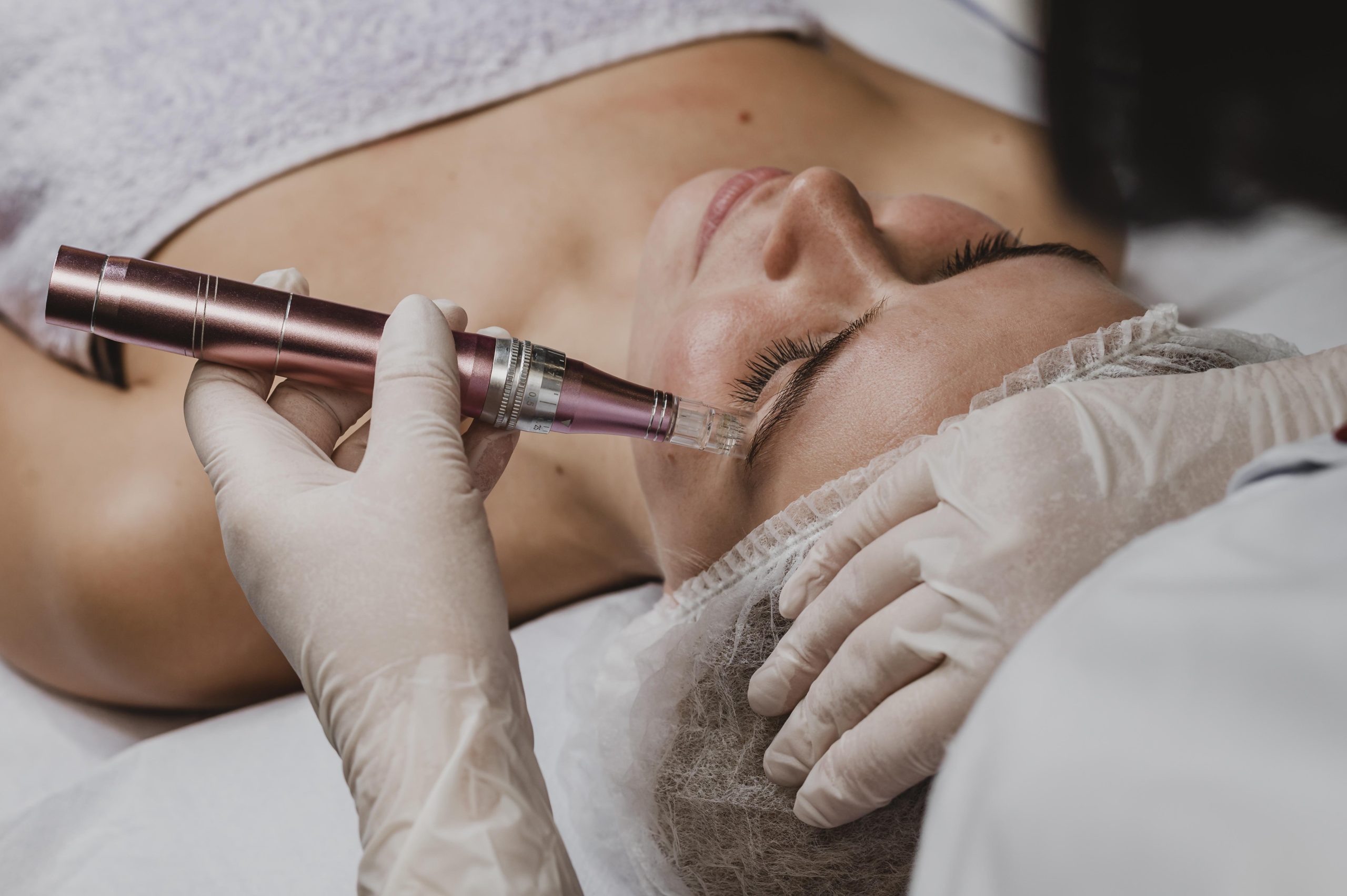Transform Your Skin with RF Microneedling in Dubai