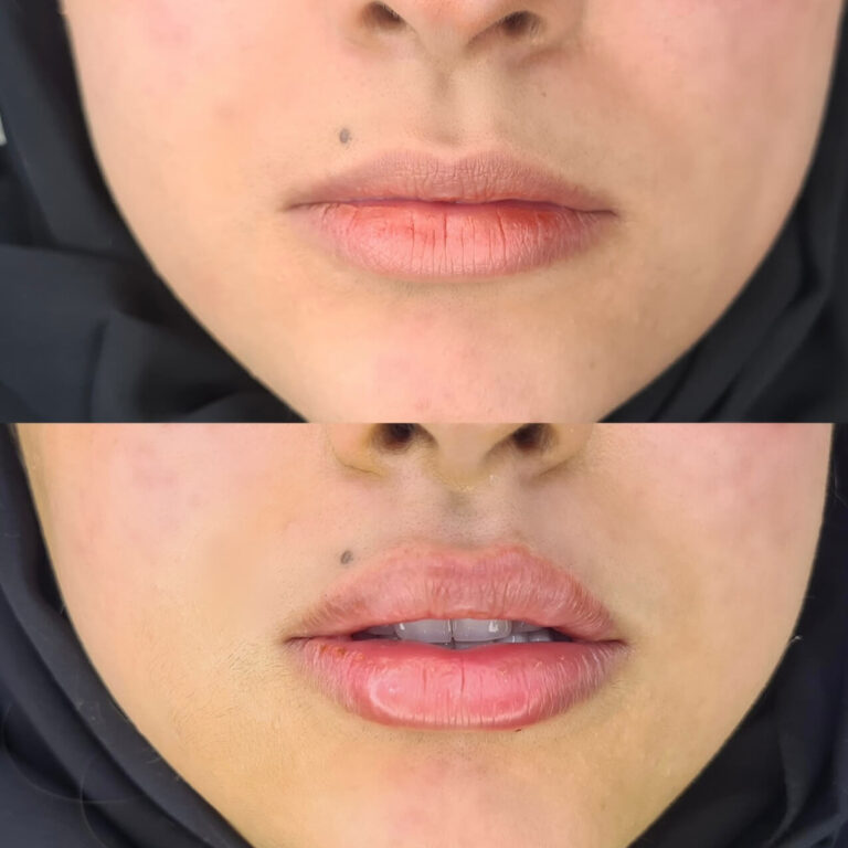 Lip Filler