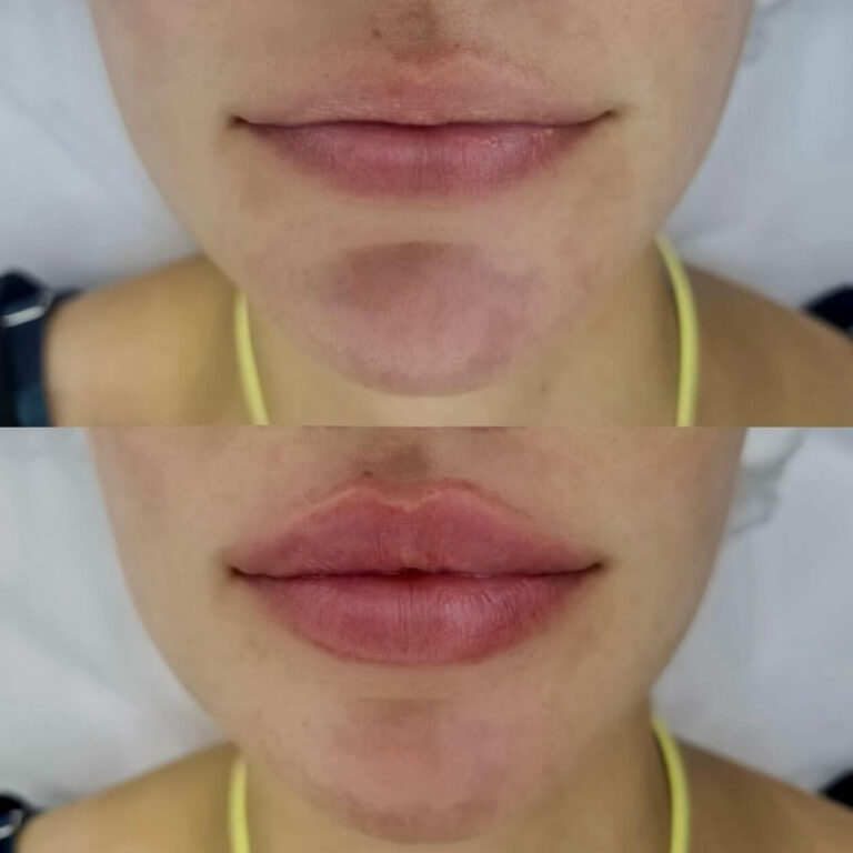 Lip Augmentation