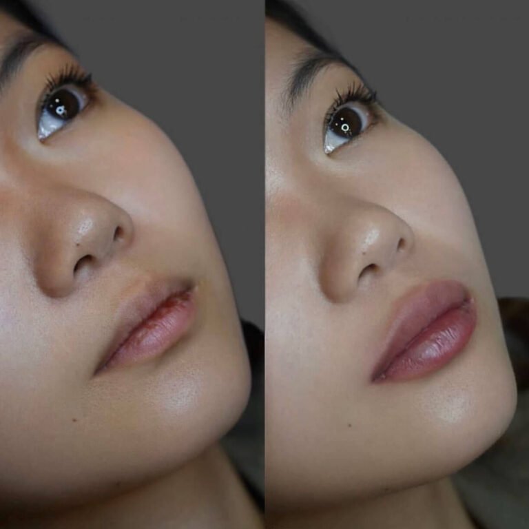 Lip Augmentation