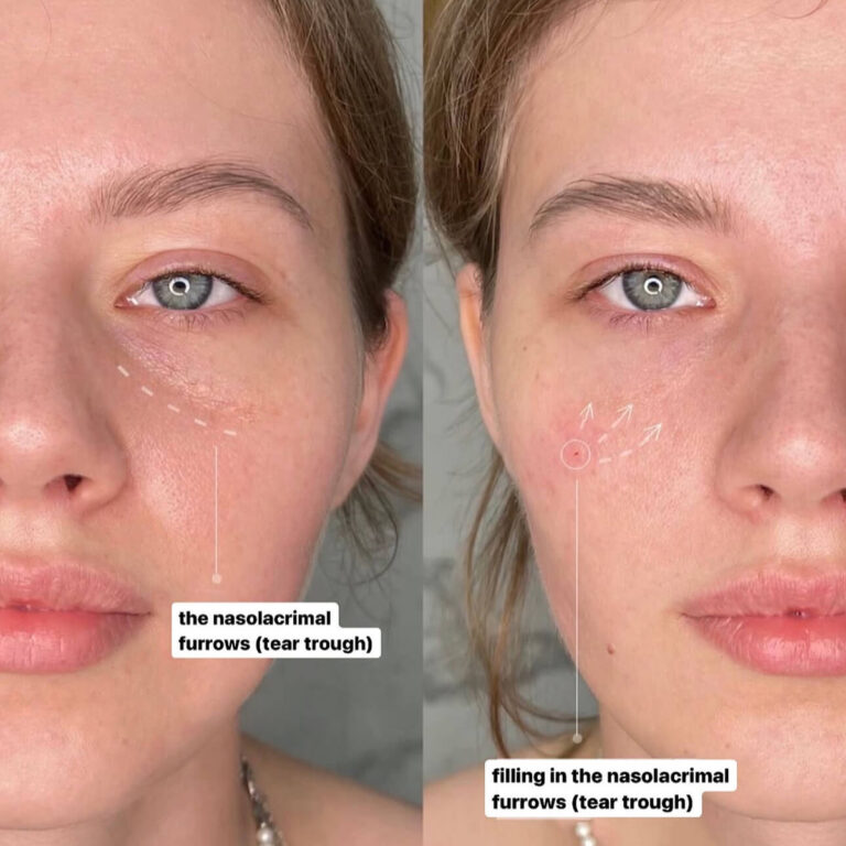 Fillers